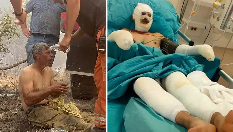 Yanıyorum Diye Feryat Eden Orman İşçisinin Tedavi Süreci Devam Ediyor