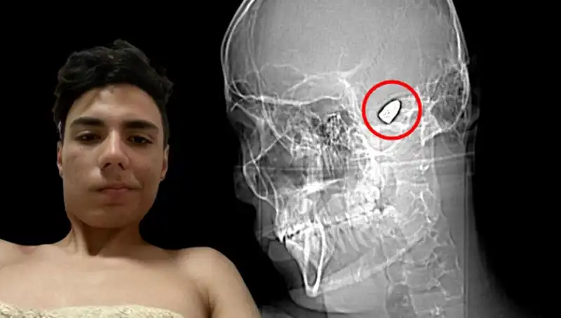 Kafasında Patlayan Bomba İle Yaşamak: Bir Hayat Mücadelesi