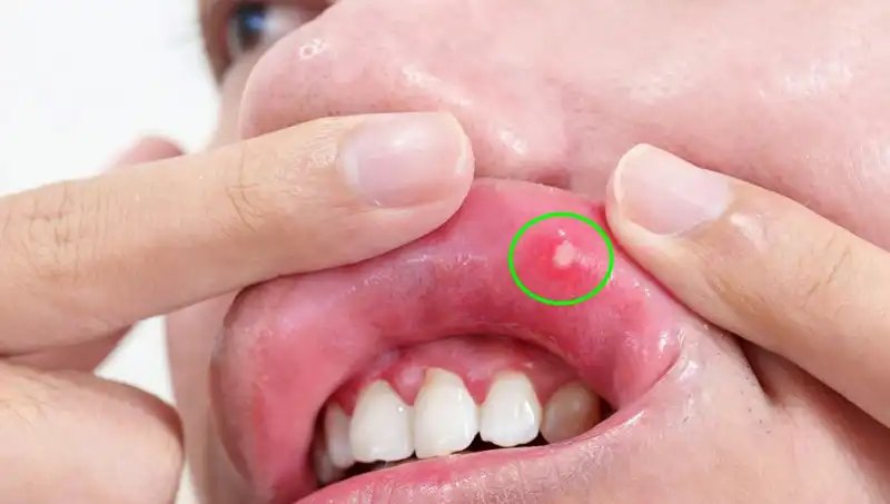 Kanser Belirtilerini Görmezden Gelen Genç Adamın Şaşırtıcı Hikayesi